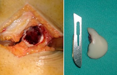 Resim 4a: Akut patella çıkığı sonrası lateral femoral kondilde kopma kırığı