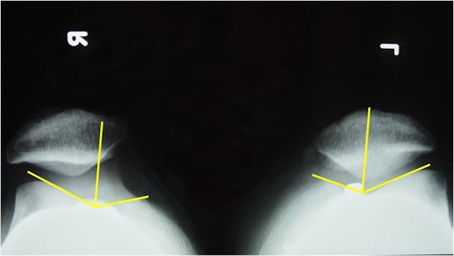 Resim 6: Kombine cerrahi sonrası dizlim. Opere olan sol tarafta patellar uyum açısı normale gelmiş. Sağ non-opere tarafta subluksasyon devam etmekte.