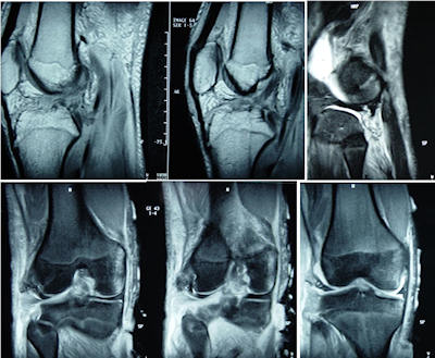 Ön ve arka çapraz bağ ile birlikte postero-lateral köşe yaralanmasının MRG görüntüleri