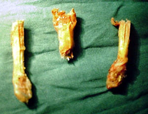 Kemik tüneller ağzında örselenmeye bağlı yırtılan Dacron sentetik bağın görünümü