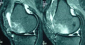 Diz ekleminde kıkırdak yaralanmasında MR görüntüsü