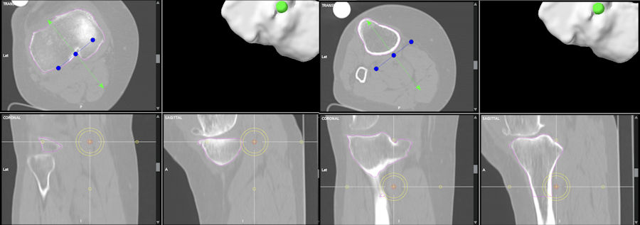 Resim 2: Üç boyutlu bilgisayarlı tomografi ile robotik diz protezi planlaması.