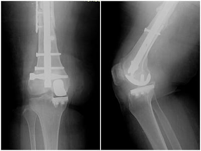 Figure 4b: the patient is treated with a partial knee replacement without removing the implants in and on the bone.