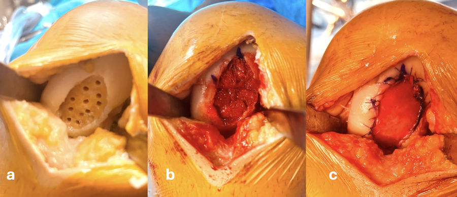 Resim 4: Geniş kıkırdak hasarı olan bir dizde matriks üzerine emdirilmiş kök hücre uygulaması; a: Hasarlı alanın hazırlanması, b: Hasarlı bölgenin tabanına kemik desteği yerleştirilmesi, c: Kemik desteğin üzerinin kök hücre emdirilmiş matriks ile örtülmesi. Aylar içinde bu bölgenin kıkırdağa dönüşmesi beklenmekte.