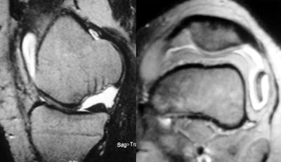 Yatağından ayrılıp lateral çıkmazda serbest cisim haline gelmiş olan osteokondritis dissekansın MR görüntüsü