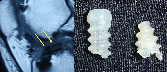 Resim 2: Eklem içine yer değiştirip kırılan bir biyobozunur vidanın MR görüntüsü ve çıkartıldıktan sonraki durumu.