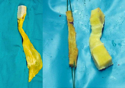 Resim 5a,b: Revizyon ön çapraz bağ cerrahisi sırasında kullanılan yumuşak doku ve kemik allogreftleri.