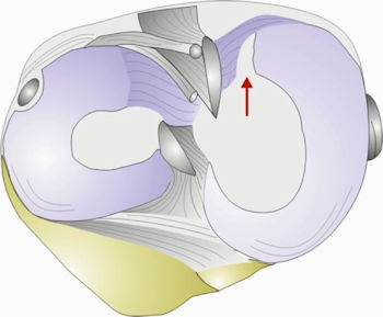 Resim 1: İç menisküs kök yırtığının şematik görünümü.