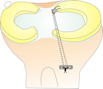 Resim 3 : Menisküs kök yırtığının onarımı kemiğe açılan tünellerden geçirilen dikişlerin, bir metal düğme üzerinde bağlanması ile yapılır.