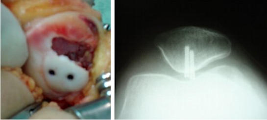 Figure 2 : X-ray of a large fragment fixed with screws after a patella dislocation.