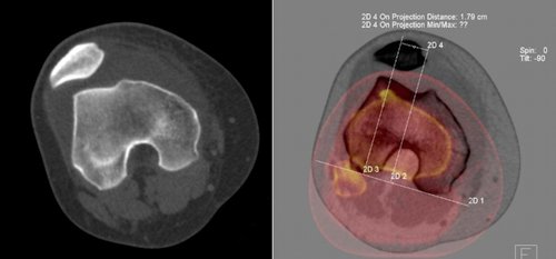 Figure 3: Planning of surgery using highly accurate MRI and CT scans for patella dislocation.