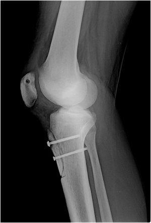 Resim 4 : Kombine cerrahi uygulanmış bir hastanın röntgen grafileri. Patella içine açılan tünelden MPFL tamiri yapılmış, ve kemik ameliyatı ile patella kemiğinin femoral oluktaki seyir yönü değiştirilmiş.