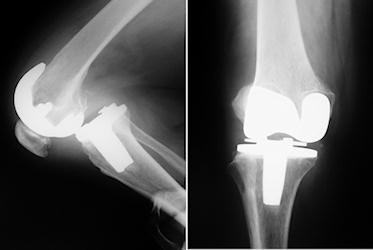 Primer artroplasti sonrası posterior instabilite