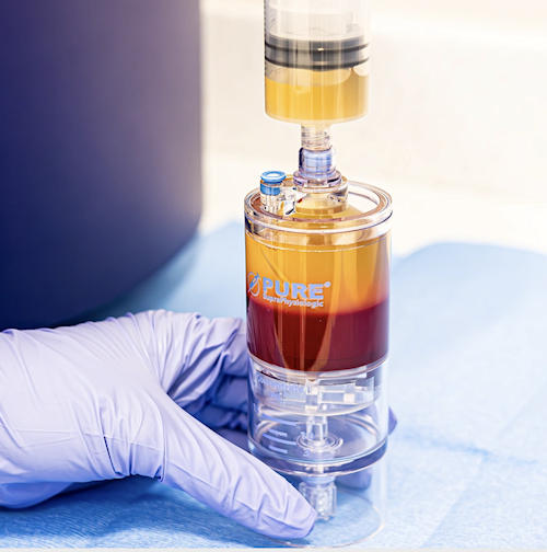 An example of modern closed system PRP kit; the Emcyte supraphysiological Pure PRP kit. (Source: https://emcyte.com/pureprp-sp/) An example of modern closed system PRP kit; the Emcyte supraphysiological Pure PRP kit. (Source: https://emcyte.com/pureprp-sp/)