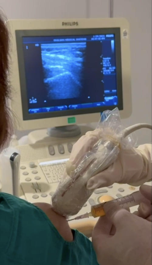 Picture 3: PRP injection to a partial tear of the supraspinatus muscle under ultrasound guidance. Picture 3: PRP injection to a partial tear of the supraspinatus muscle under ultrasound guidance.