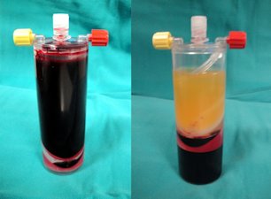 Solda PRP hazırlanmadan önce hastanın kanı, sağda PRP filtre edilerek ayrıldıktan sonraki görünüm