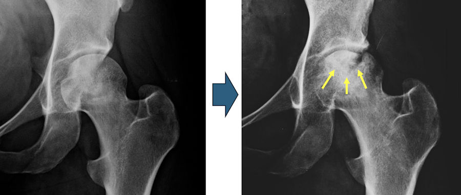 Resim 2: Femur başı avasküler nekrozunda hastalığın ilerlemesini gösteren röntgen grafileri. İlk röntgende femur başının yuvarlaklığı korunmuş, iki yıl sonraki röntgende femur başı deforme olmuş. Oklar beslenmeyen bölgedeki çökmeyi  göstermekte.