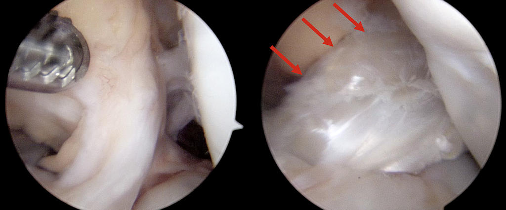Resim 2: Ön çapraz bağ onarımının artroskopik görüntüsü, çocuğun kendi dokusu kullanılarak yeni bir bağ yapılmış.