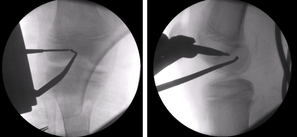 Resim 3: Büyüme kıkırdağı açık olan bir çocukta ameliyat sırasında skopi (röntgen) kontrolü altında ön çapraz bağ onarımı için uygun kemik tünellerin açılması.