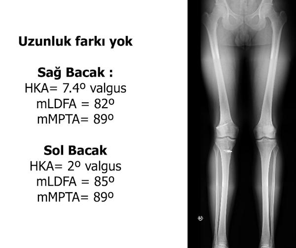 Resim 4: Büyüme tamamlanana kadar her iki bacağın tamamını içeren röntgenler ile bacak uzunluğu ve açısal dizilimin ölçülmesi.