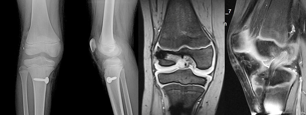 Resim 5: “Fizis koruyucu” ön çapraz bağ onarımı yapılmış bir çocuğun röntgen ve MR kontrol görüntüleri