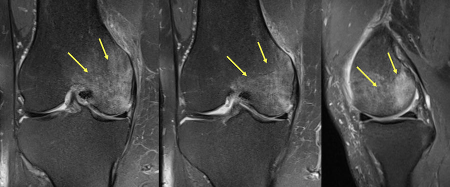 Resim 7: Femur kemiği iç tarafında oklar ile işaretli yaygın kemik iliği ödemi alanı (Normal kemik iliği gri renklidir, ödem alanı beyaz olarak görülür).