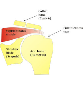 Figure  2: Full thickness rotator cuff tear