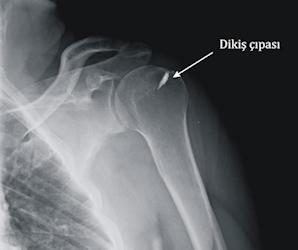 Resim 6: Dikiş çapası ile rotator manşet onarımı yapılan hastanın ameliyat sonrası röntgen grafisi