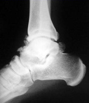 Erken artroz ile birlikte futbolcu ayak bileği