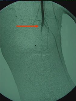 Çoklu bağ yaralanması sonrası popliteal arter tam oklüzyonunu gösteren anjiyogram