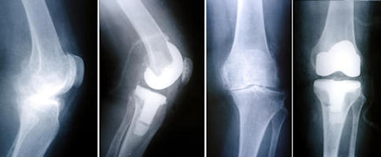 Diz protezi yapılmış bir hastanın ameliyat öncesi ve sonrası röntgen görüntüleri 